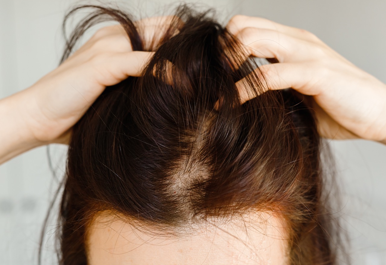 woman showing thinning hair and visible scalp