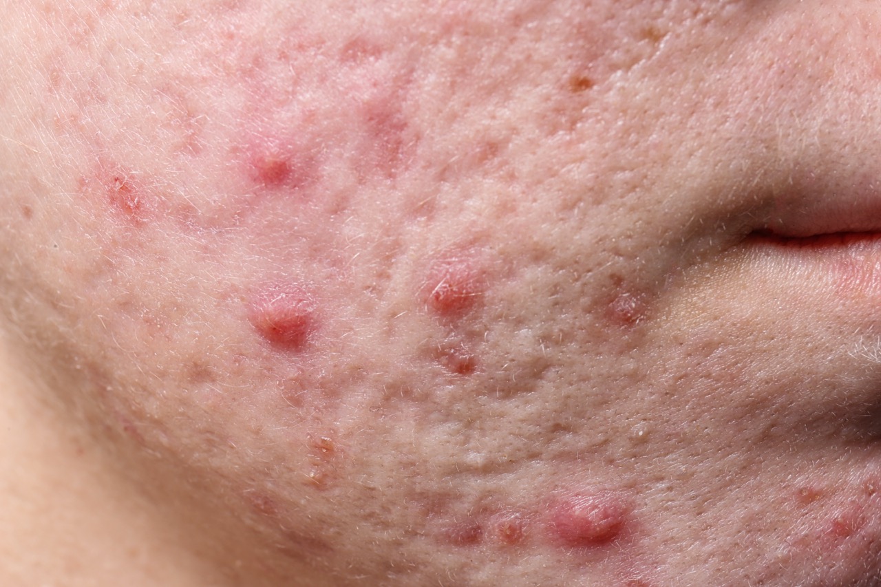 Glutathione Injection For Skin Whitening: Cost, Benefits And Side Effects
