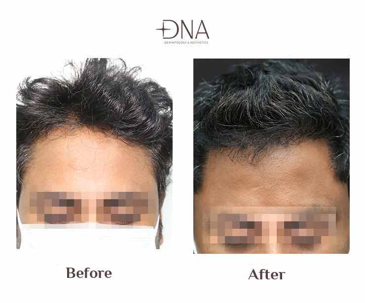 Hair Transplant in Bangalore