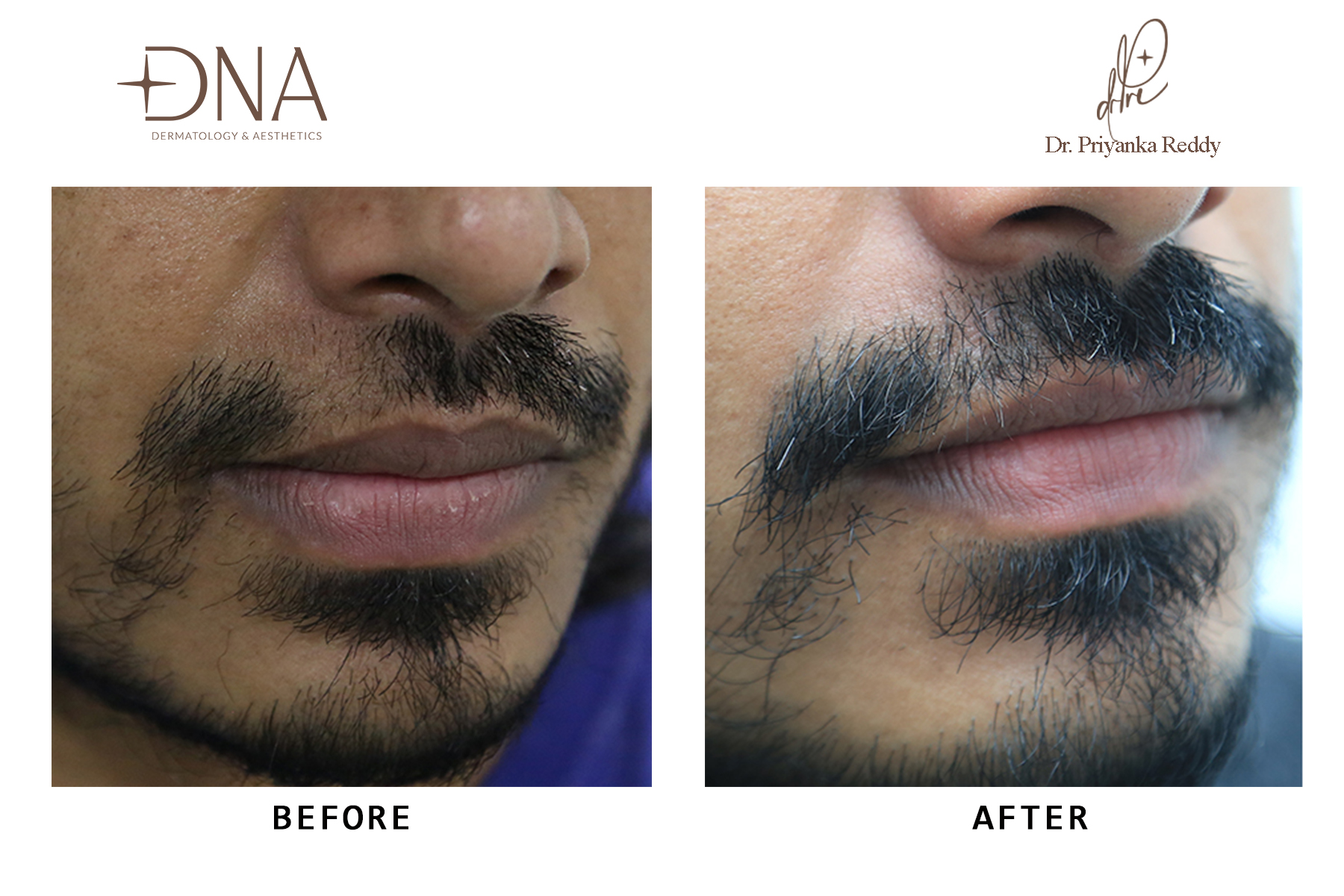 Before Alopecia Areata