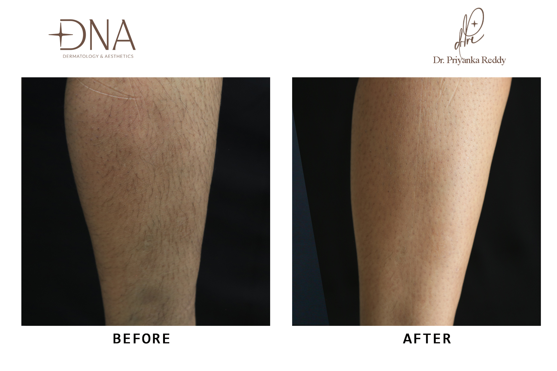 Before Laser Hair Removal